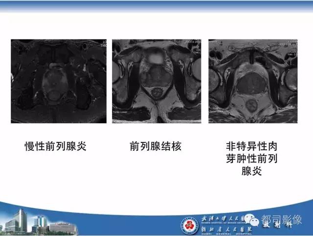 【PPT】前列腺癌高分辨率DWI临床应用