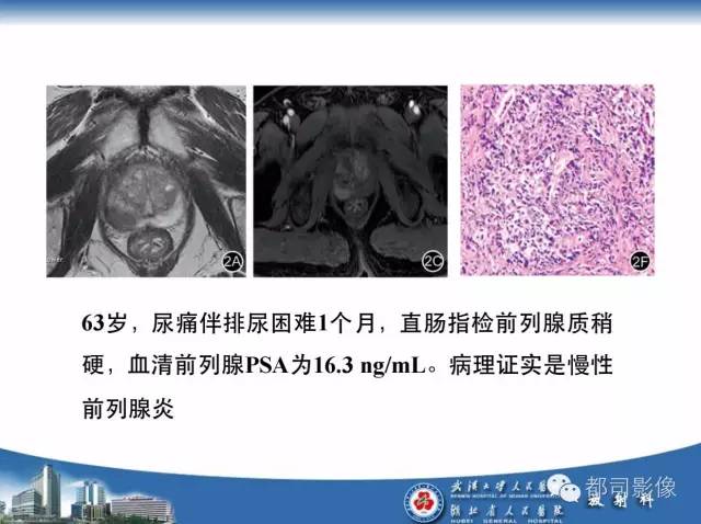 【PPT】前列腺癌高分辨率DWI临床应用