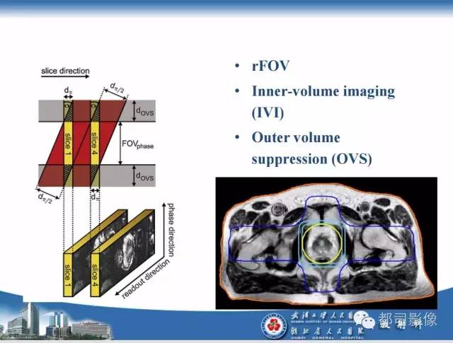 【PPT】前列腺癌高分辨率DWI临床应用
