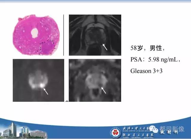 【PPT】前列腺癌高分辨率DWI临床应用