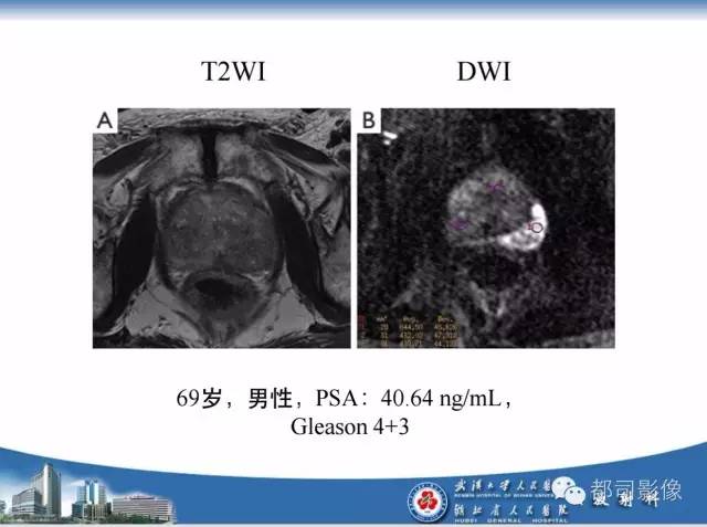 【PPT】前列腺癌高分辨率DWI临床应用