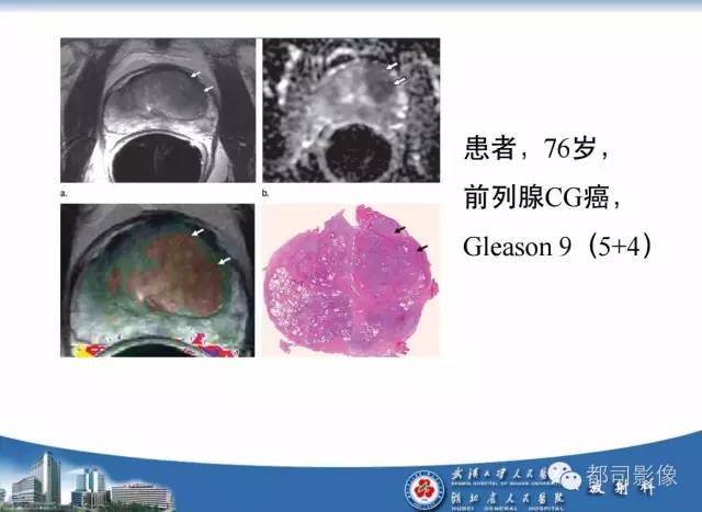 【PPT】前列腺癌高分辨率DWI临床应用