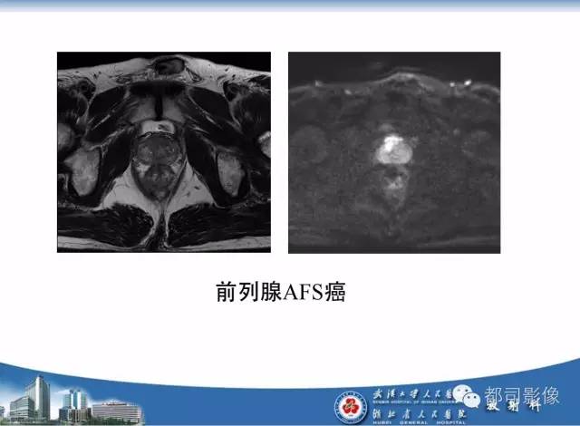 【PPT】前列腺癌高分辨率DWI临床应用