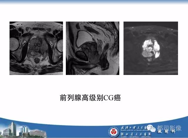 【PPT】前列腺癌高分辨率DWI临床应用
