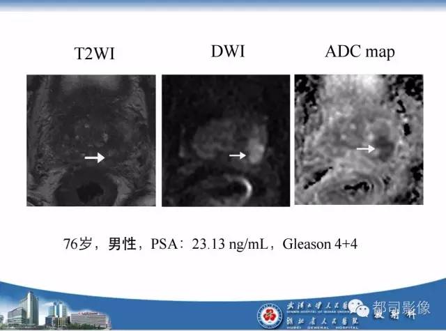 【PPT】前列腺癌高分辨率DWI临床应用