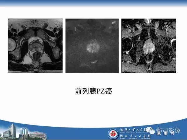 【PPT】前列腺癌高分辨率DWI临床应用