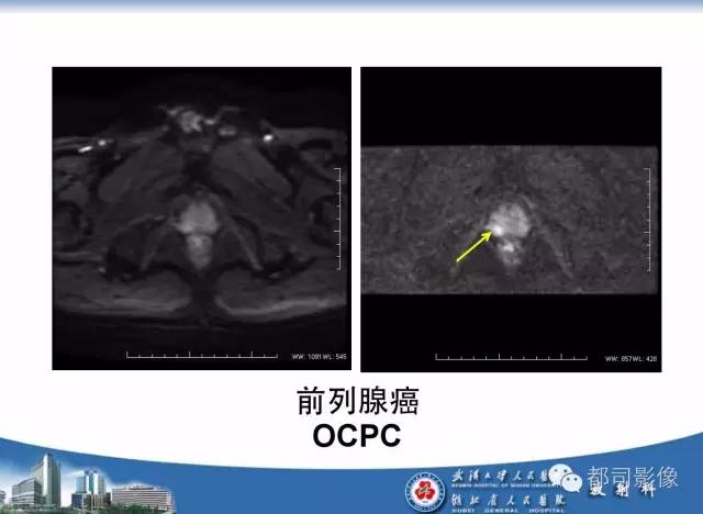【PPT】前列腺癌高分辨率DWI临床应用