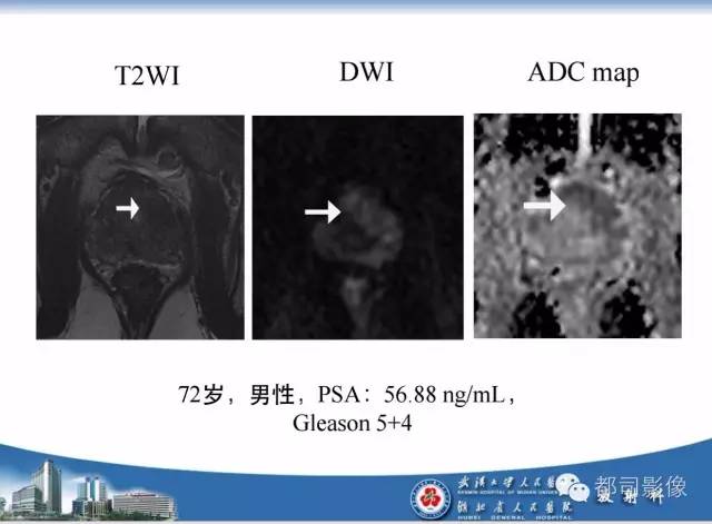 【PPT】前列腺癌高分辨率DWI临床应用
