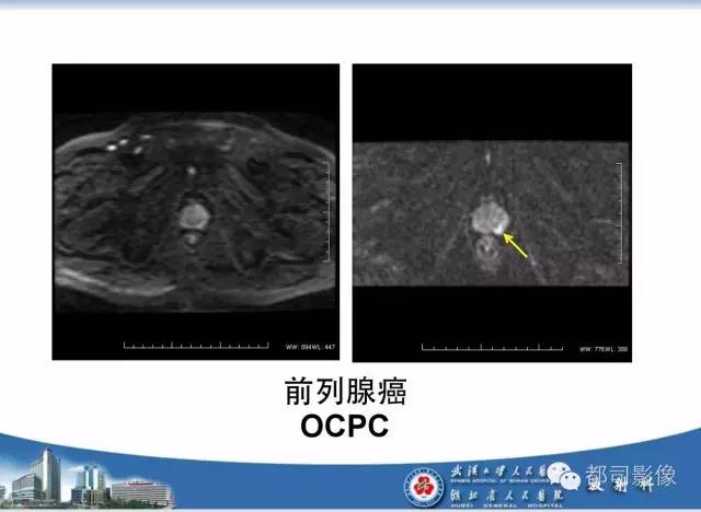 【PPT】前列腺癌高分辨率DWI临床应用