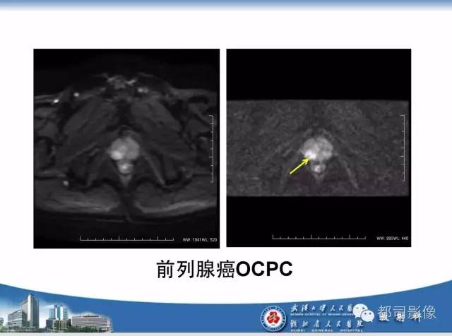 【PPT】前列腺癌高分辨率DWI临床应用