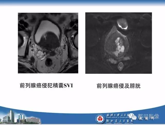 【PPT】前列腺癌高分辨率DWI临床应用