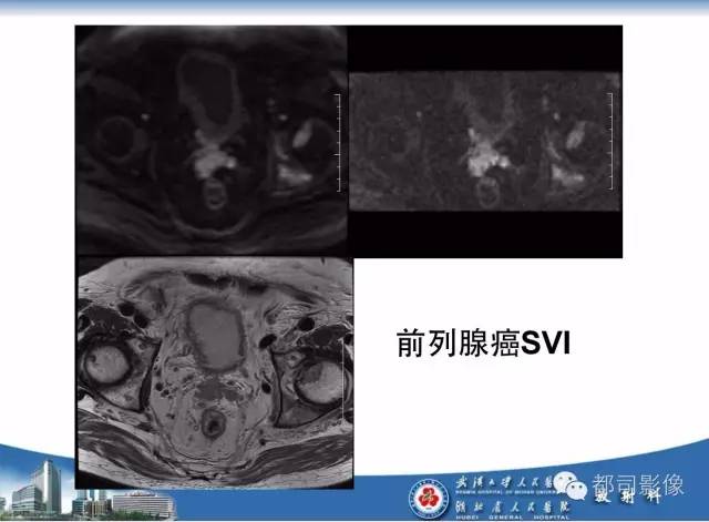【PPT】前列腺癌高分辨率DWI临床应用