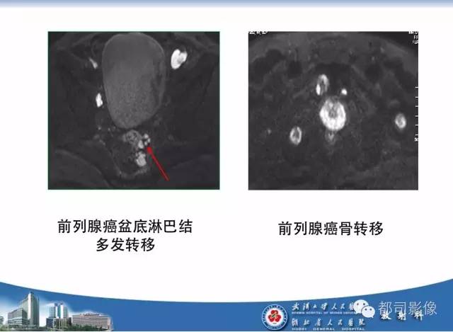 【PPT】前列腺癌高分辨率DWI临床应用