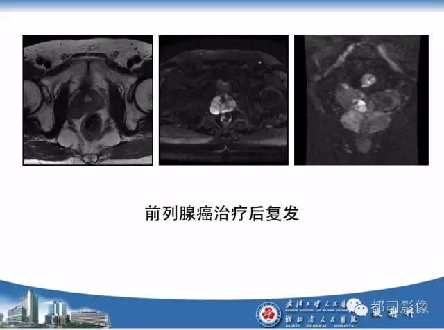 【PPT】前列腺癌高分辨率DWI临床应用