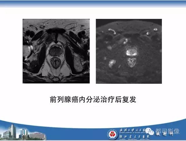 【PPT】前列腺癌高分辨率DWI临床应用