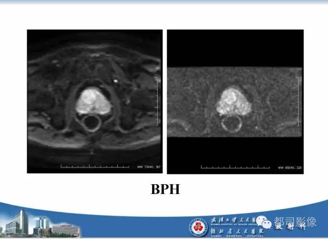 【PPT】前列腺癌高分辨率DWI临床应用