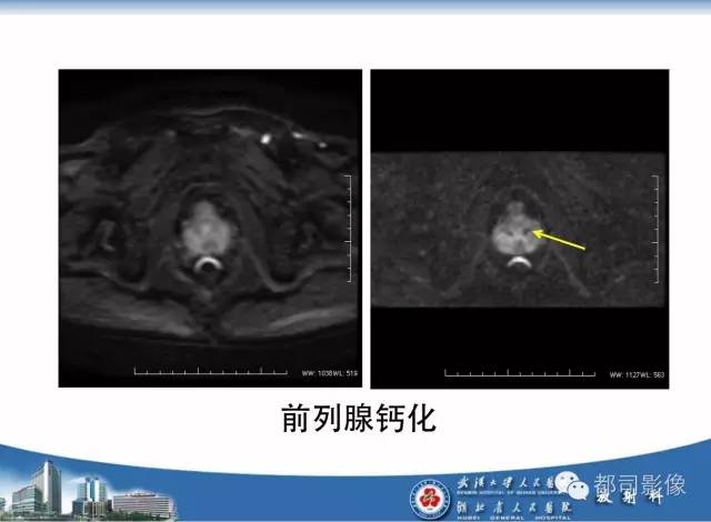 【PPT】前列腺癌高分辨率DWI临床应用