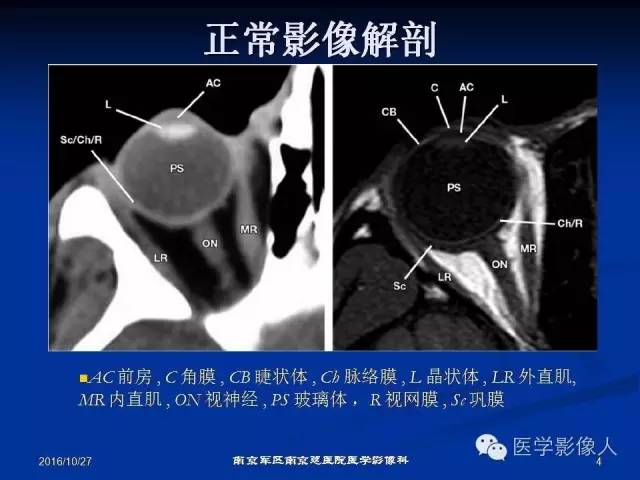 【PPT】眼外伤影像学表现【RG精选】