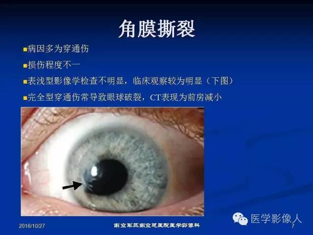 【PPT】眼外伤影像学表现【RG精选】