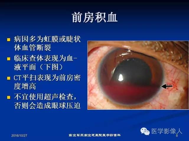 【PPT】眼外伤影像学表现【RG精选】