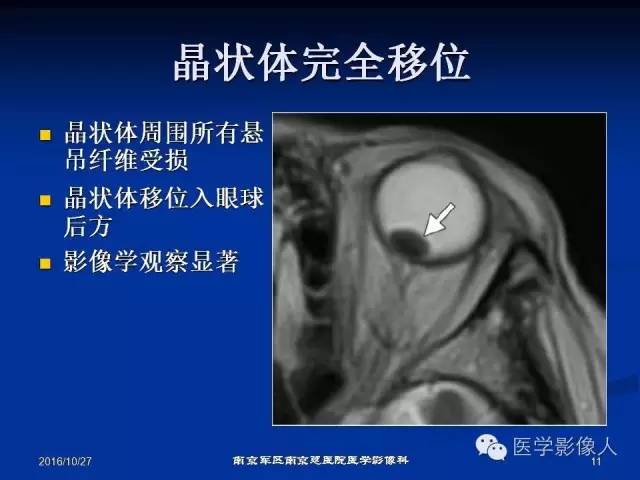 【PPT】眼外伤影像学表现【RG精选】