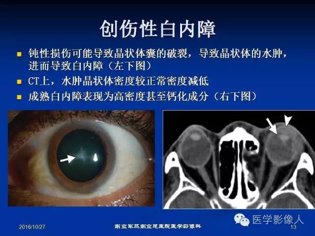 【PPT】眼外伤影像学表现【RG精选】