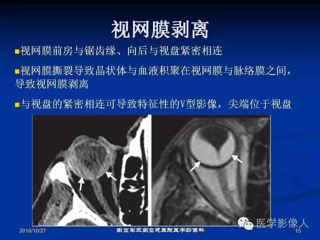 【PPT】眼外伤影像学表现【RG精选】