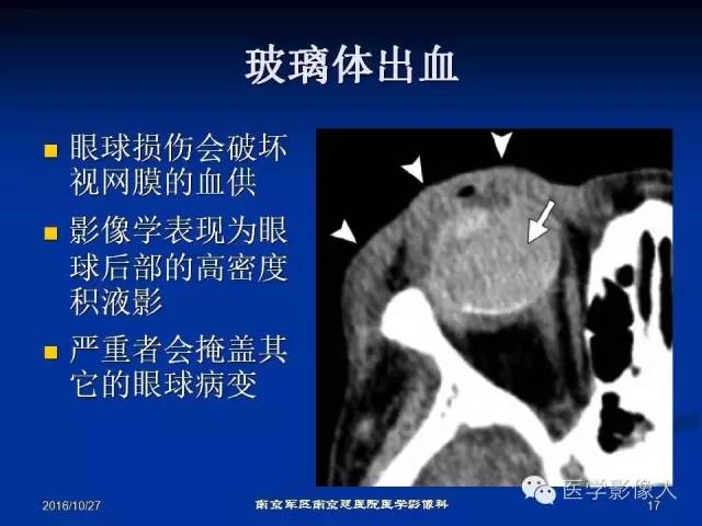 【PPT】眼外伤影像学表现【RG精选】