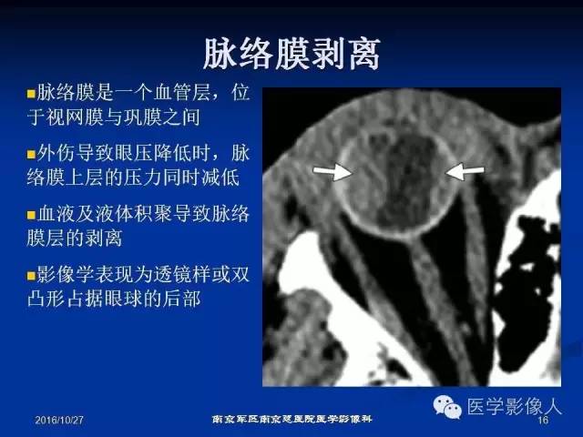 【PPT】眼外伤影像学表现【RG精选】
