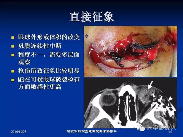 【PPT】眼外伤影像学表现【RG精选】