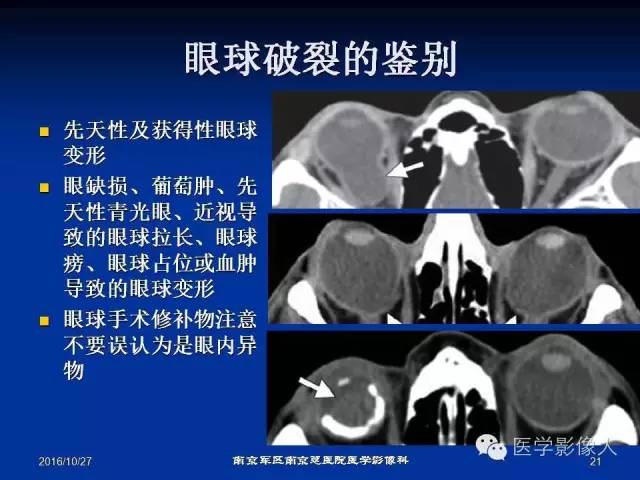 【PPT】眼外伤影像学表现【RG精选】