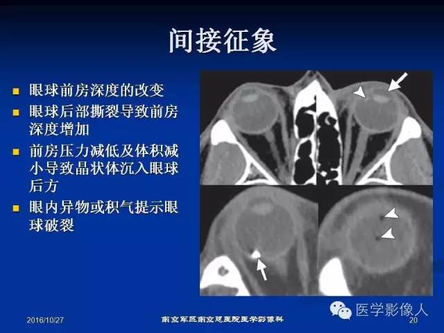 【PPT】眼外伤影像学表现【RG精选】