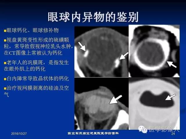 【PPT】眼外伤影像学表现【RG精选】