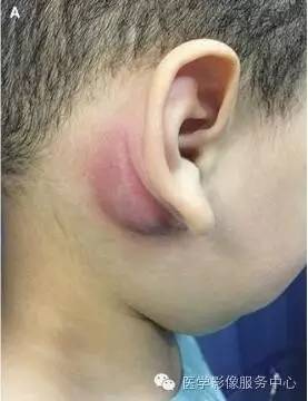 【病例】第一鳃裂囊肿1例CT,附四种类型的鉴别要点 【病例】第一鳃裂囊肿1例CT,附四种类型的鉴别要点