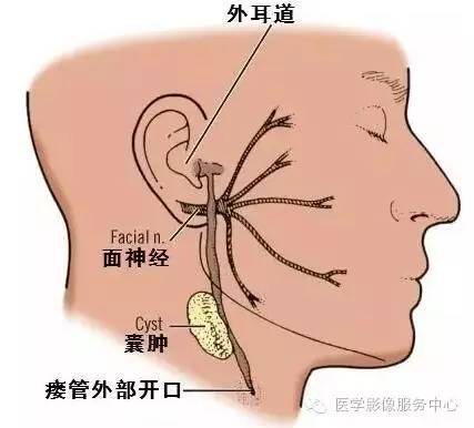 【病例】第一鳃裂囊肿1例CT,附四种类型的鉴别要点 【病例】第一鳃裂囊肿1例CT,附四种类型的鉴别要点