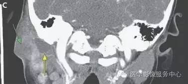 【病例】第一鳃裂囊肿1例CT,附四种类型的鉴别要点 【病例】第一鳃裂囊肿1例CT,附四种类型的鉴别要点