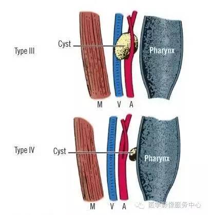 【病例】第一鳃裂囊肿1例CT,附四种类型的鉴别要点 【病例】第一鳃裂囊肿1例CT,附四种类型的鉴别要点