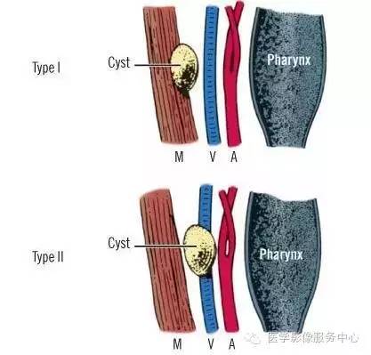 【病例】第一鳃裂囊肿1例CT,附四种类型的鉴别要点 【病例】第一鳃裂囊肿1例CT,附四种类型的鉴别要点