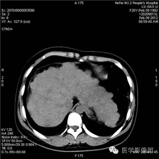 【病例】肝硬化(肝豆状核变性)1例CT影像表现 【病例】肝硬化(肝豆状核变性)1例CT影像表现