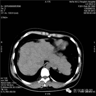 【病例】肝硬化(肝豆状核变性)1例CT影像表现 【病例】肝硬化(肝豆状核变性)1例CT影像表现