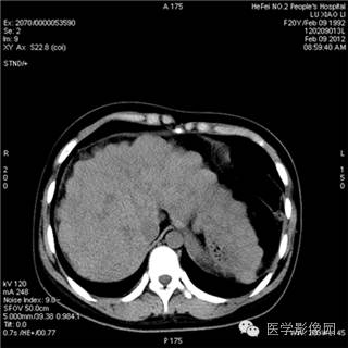 【病例】肝硬化(肝豆状核变性)1例CT影像表现 【病例】肝硬化(肝豆状核变性)1例CT影像表现