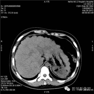 【病例】肝硬化(肝豆状核变性)1例CT影像表现 【病例】肝硬化(肝豆状核变性)1例CT影像表现
