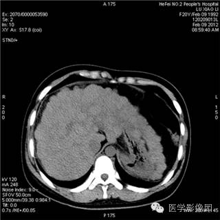【病例】肝硬化(肝豆状核变性)1例CT影像表现 【病例】肝硬化(肝豆状核变性)1例CT影像表现