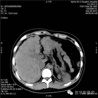 【病例】肝硬化(肝豆状核变性)1例CT影像表现 【病例】肝硬化(肝豆状核变性)1例CT影像表现