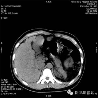 【病例】肝硬化(肝豆状核变性)1例CT影像表现 【病例】肝硬化(肝豆状核变性)1例CT影像表现