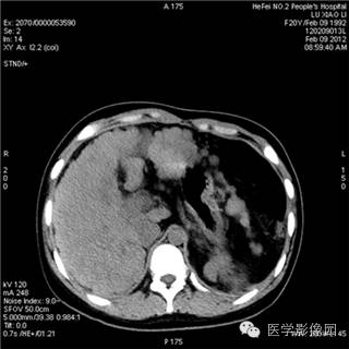 【病例】肝硬化(肝豆状核变性)1例CT影像表现 【病例】肝硬化(肝豆状核变性)1例CT影像表现