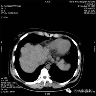 【病例】肝硬化(肝豆状核变性)1例CT影像表现 【病例】肝硬化(肝豆状核变性)1例CT影像表现