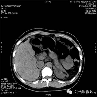 【病例】肝硬化(肝豆状核变性)1例CT影像表现 【病例】肝硬化(肝豆状核变性)1例CT影像表现