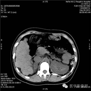 【病例】肝硬化(肝豆状核变性)1例CT影像表现 【病例】肝硬化(肝豆状核变性)1例CT影像表现