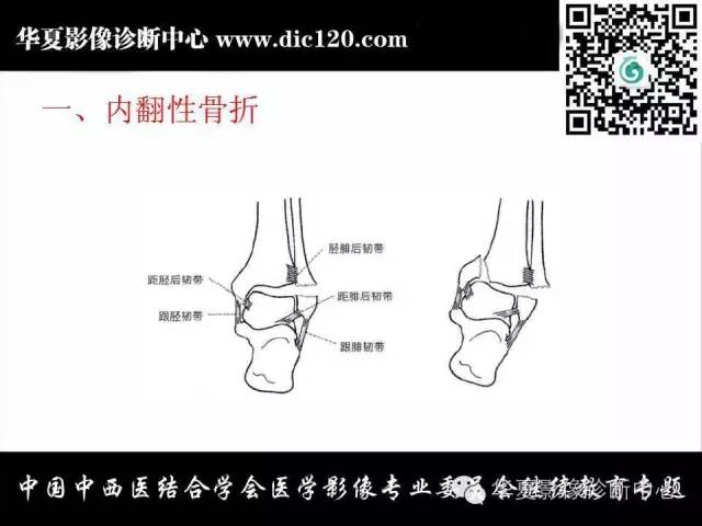 【PPT】踝关节外伤及先天性病变的影像诊断